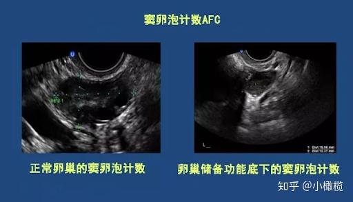 代生孩子费用是多少双胞胎减胎有风险吗